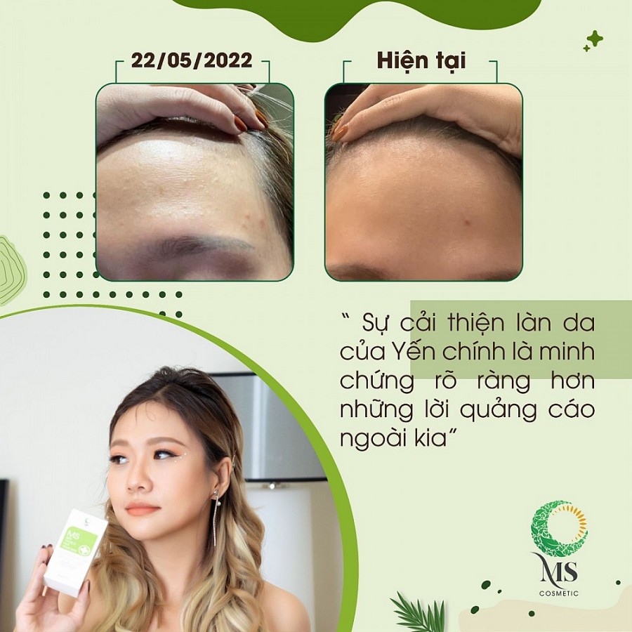 Dịp lễ 2/9, thanh lăn mụn Ms Cosmetic khuyến mãi hấp dẫn