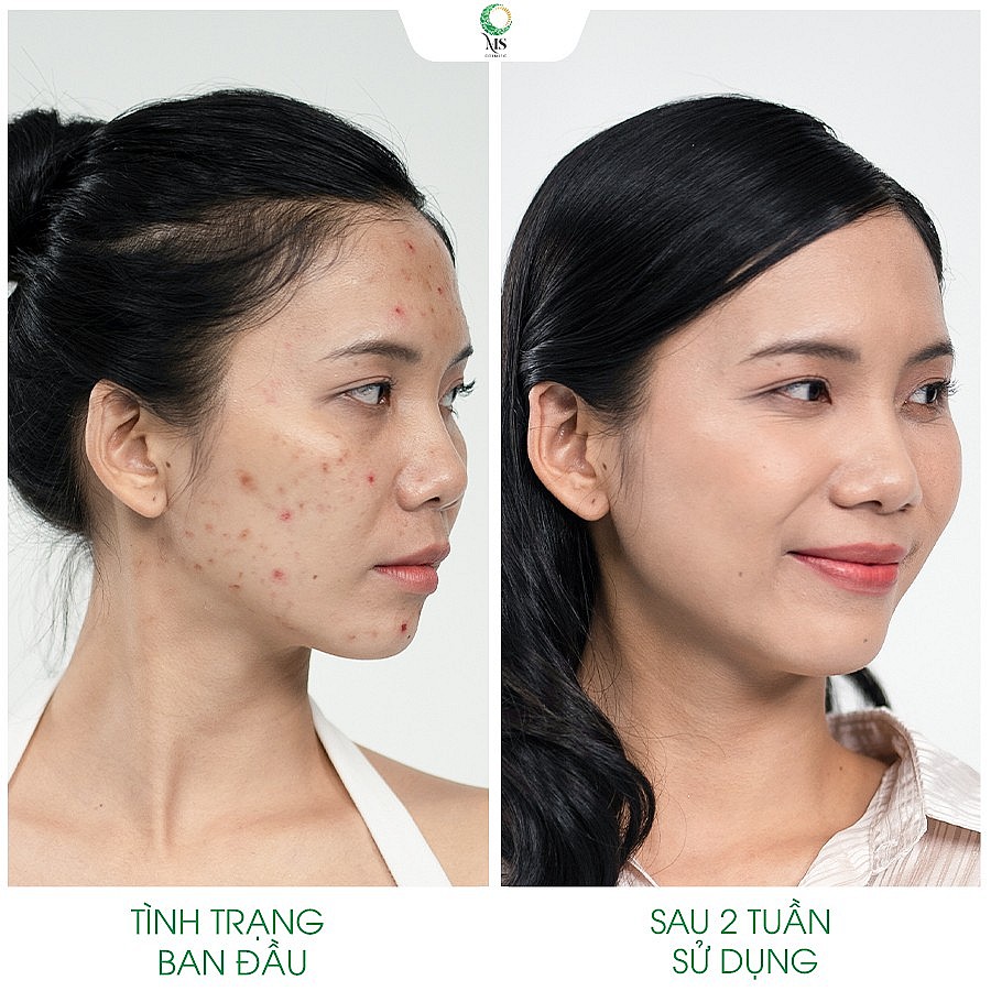 Dịp lễ 2/9, thanh lăn mụn Ms Cosmetic khuyến mãi hấp dẫn