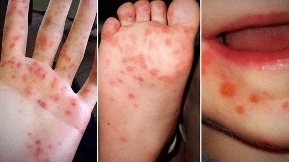 Gần 9.000 ca tay chân miệng, 3 ca tử vong, Bộ Y tế chỉ đạo tăng cường phòng chống - Ảnh 1.