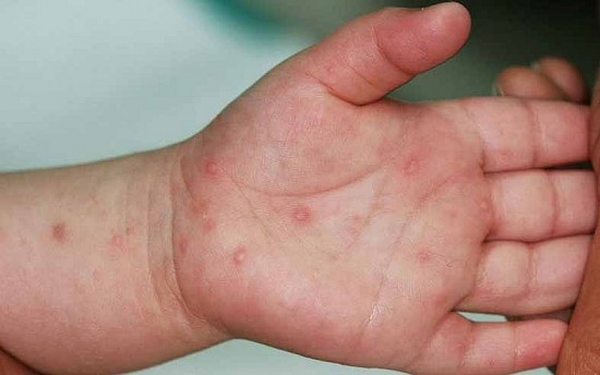 Đã có thêm 6.000 chai thuốc Immunoglobulin điều trị bệnh tay chân miệng