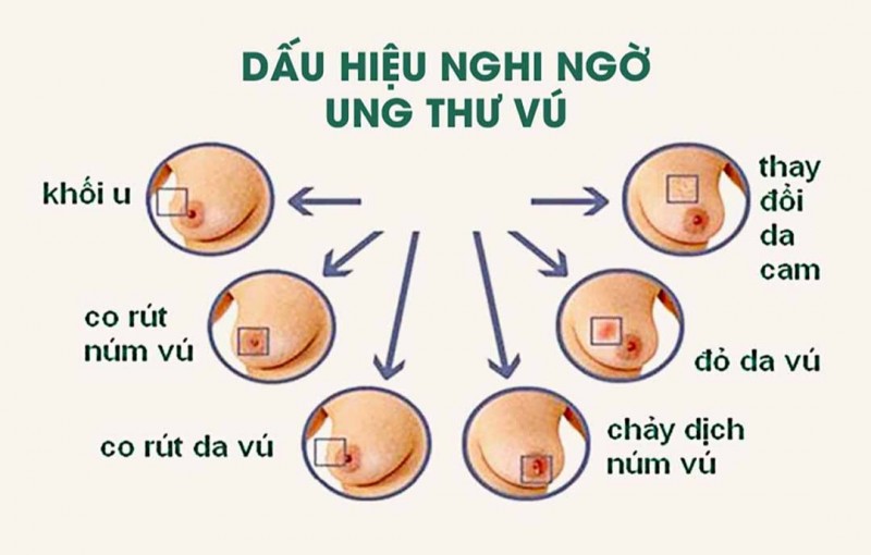 Những dưỡng chất và thực phẩm giúp giảm nguy cơ ung thư vú