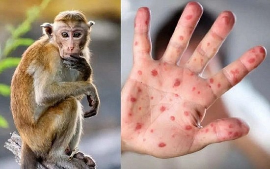 Bến Tre xuất hiện ca mắc đậu mùa khỉ đầu tiên