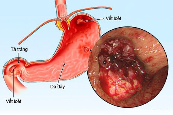 Viêm loét dạ dày nên kiêng gì và ăn gì?