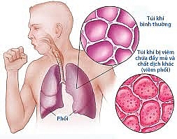 viem phoi nguyen nhan tu vong hang dau trong cac benh ve duong ho hap